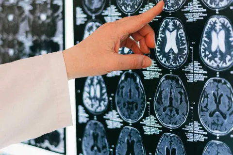 a doctor pointing at a brain scan
